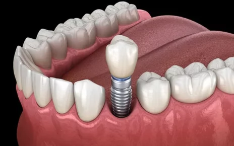 Dental Implants In Abu Dhabi