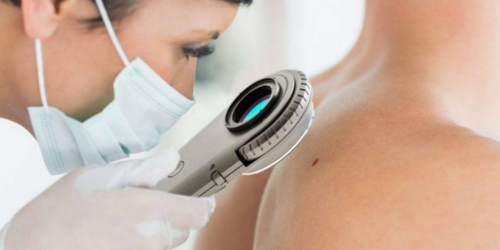 AviClear Laser Treatment