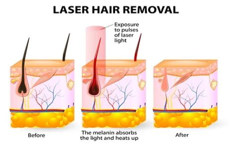 laser hair removal procedure in India