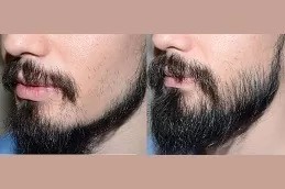 Beard Hair Transplant in Abu Dhabi